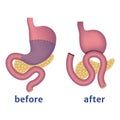 Stomach resection according to the Billroth method 2. Royalty Free Stock Photo